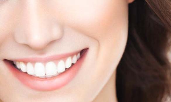 Diş Beyazlatma - Estetik Diş