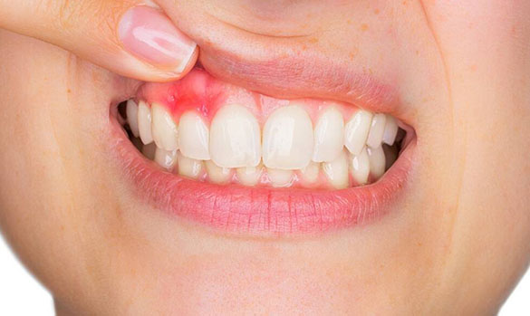 Diş Eti Hastalıkları ve Cerrahisi - Periodontoloji