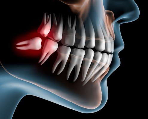 Gömülü Dişler Alındıktan Sonra Hastaların Uyması Gereken Kurallar